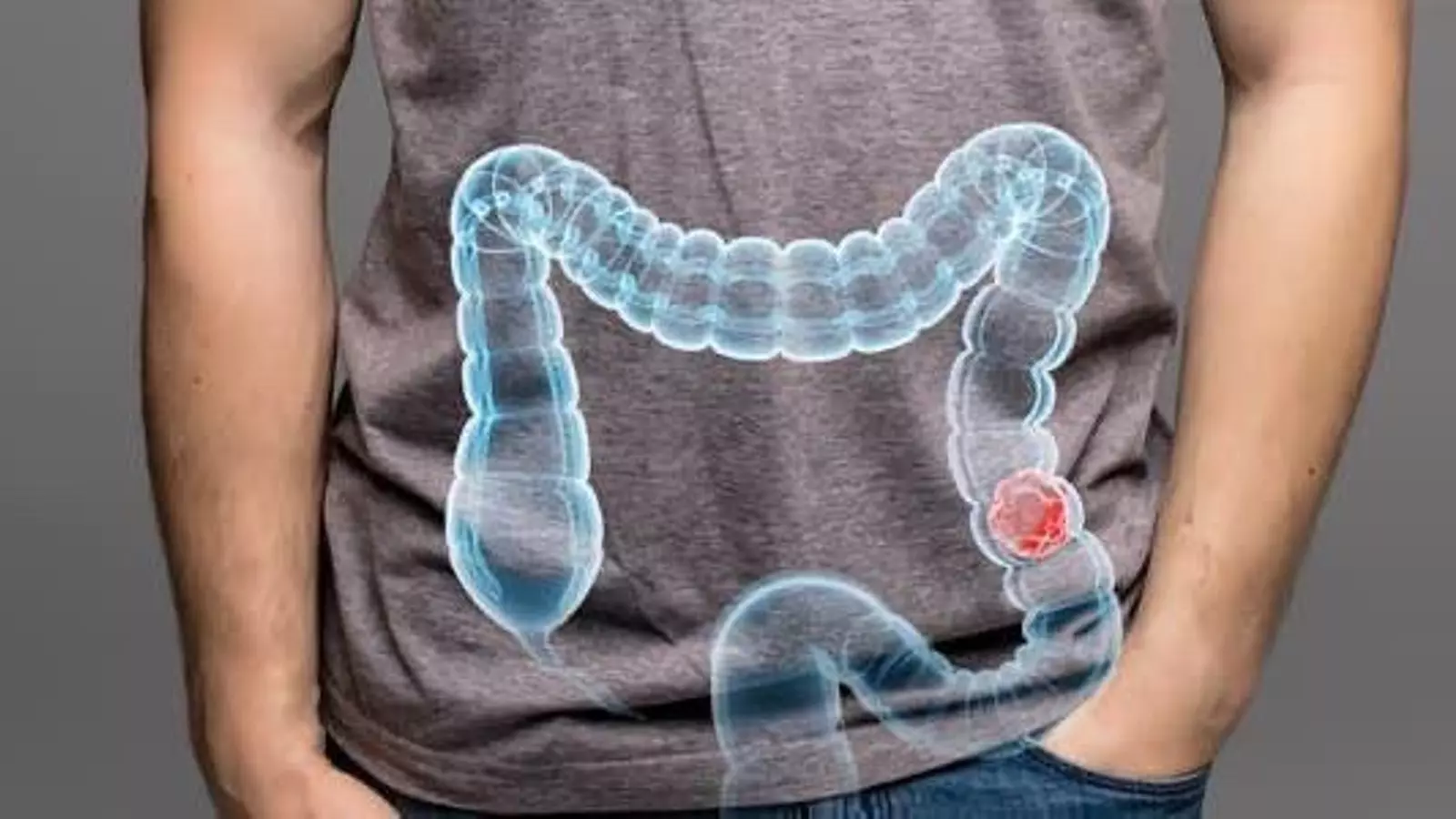 Identifican la clave para frenar la metástasis del cáncer colorrectal