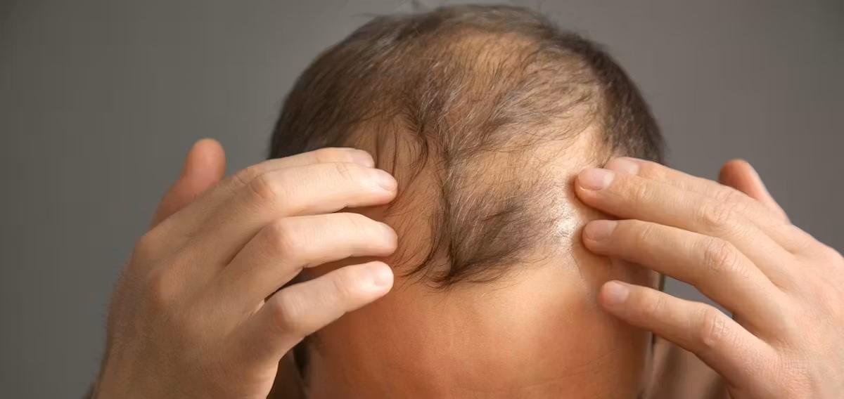 La terapia celular abre una nueva vía para acabar con la calvicie