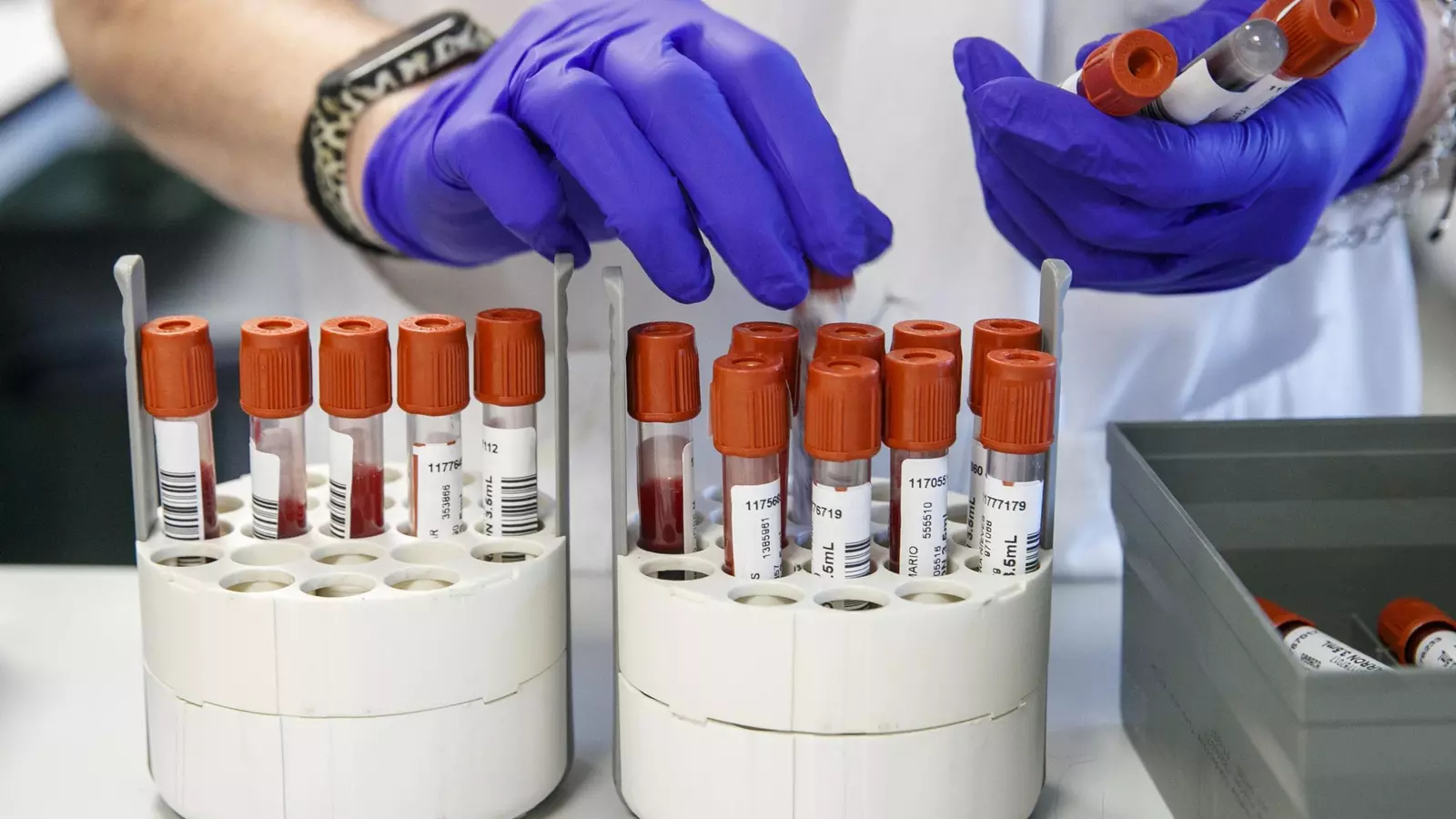 España, cerca de ser el primer país del mundo en eliminar la hepatitis C