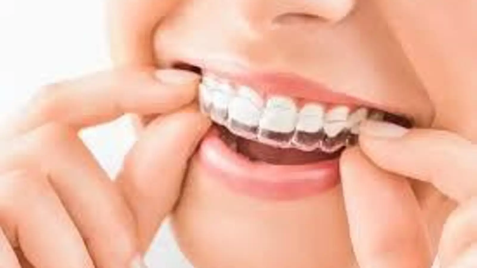 Consejos para cuidar la higiene bucodental y el tratamiento de ortodoncia invisible en verano